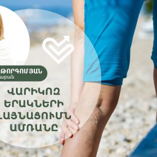 Վարիկոզ երակների լայնացումն ամռանը