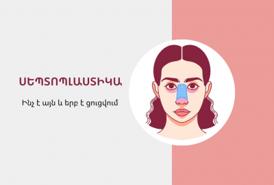 Սեպտոպլաստիկա. ինչ է այն և երբ է ցուցվում