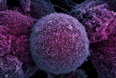 Ученые США: вазэктомия ведет к раку простаты