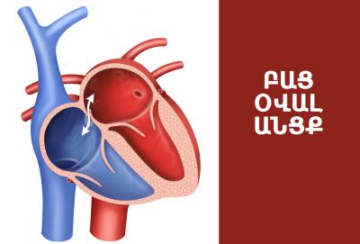 Բաց օվալ անցք. ներկայացնում է սրտաբան Հասմիկ Աղաջանյանը