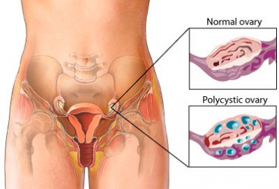 Letrozole versus Clomiphene for Infertility in the Polycystic Ovary Syndrome