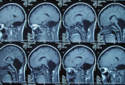 Woman With No Cerebellum Has Only Mild To Moderate Symptoms, Despite Huge Neuron Lack