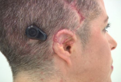 Хирурги вернули слух женщине, появившейся на свет без ушей