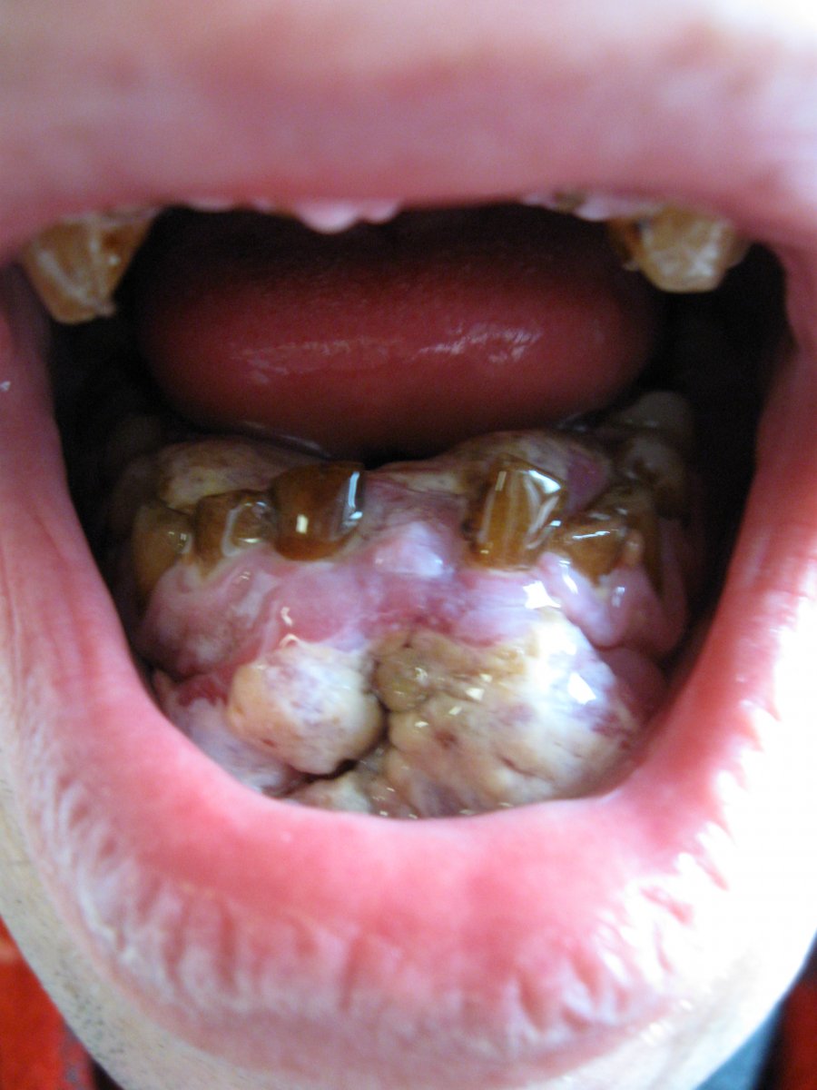 Բերանի խոռոչի լորձաթաղանթի քաղցկեղ