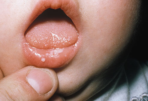 Инфекционное заболевания полости рта