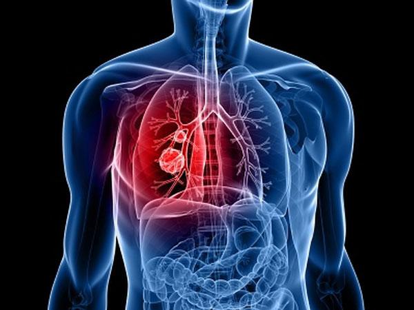 Թոքի քաղցկեղը` քաղցկեղից մահվան դեպքերի հիմնական պատճառ