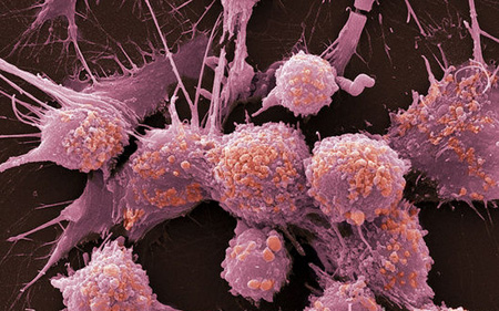 Քաղցկեղի ախտորոշում և բուժում, քաղցկեղի բուժման նոր մեթոդներ